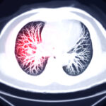 Autopsies Show Covid Deaths Due to Blood Clots